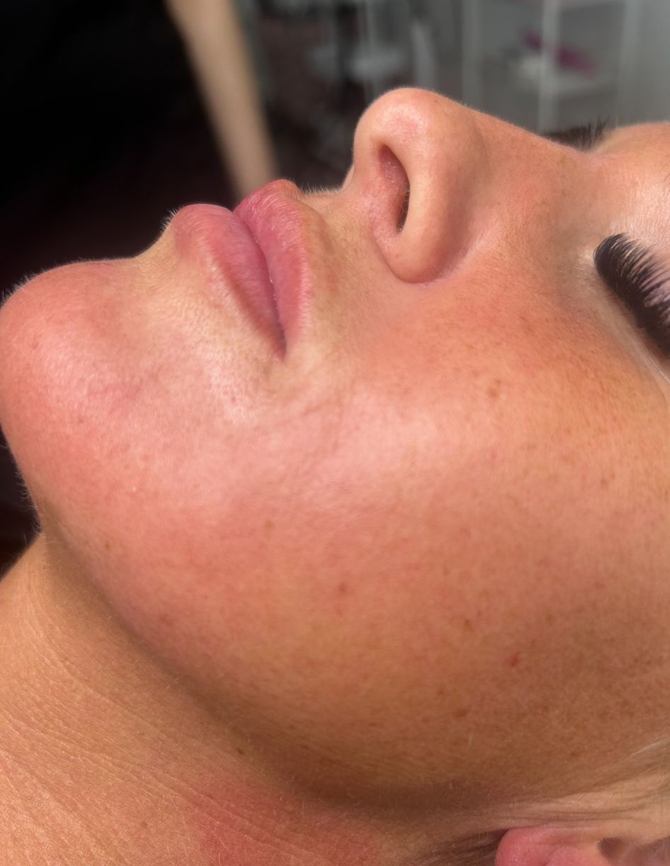 Beauty procedure by Caroline Gillott from Aesthetic Atelier